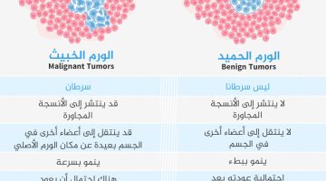 كيف نميّز بين الورم الحميد والخبيث؟ وما الفرق بين الكتل الحميدة والسرطان في الثدي؟ | صحة – البوكس نيوز