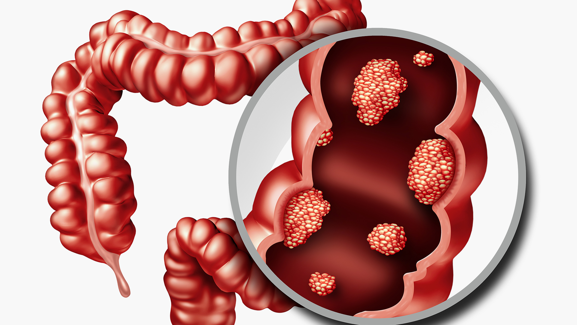 تغيرات طارئة قد تشير إلى سرطان القولون | صحة – البوكس نيوز