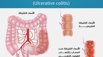 فائدة مذهلة لعصير الملفوف الأحمر لعلاج التهاب الأمعاء ومرض كرون والتهاب القولون التقرحي | صحة – البوكس نيوز