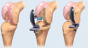 جراحة استبدال مفصل الركبة.. متى تكون ضرورية؟